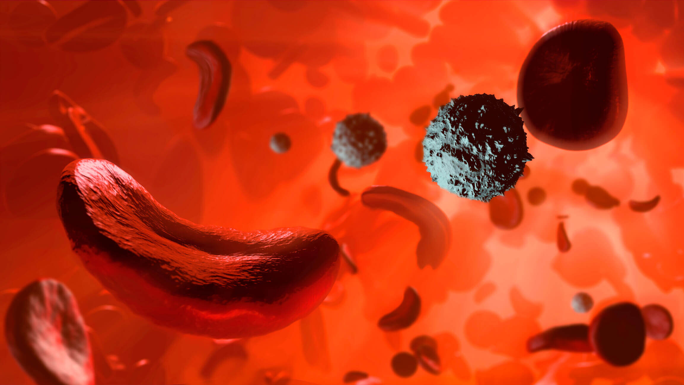 New Hope for a Once Neglected Disease: Advances in Sickle Cell Treatments