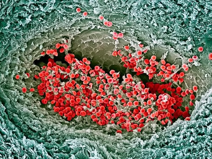f0012100-blood_clot_sem.jpg