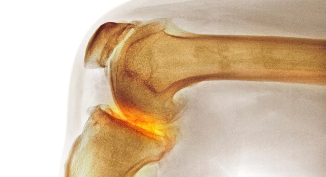 knee_xray_title_gettyimages-122374297.jpg