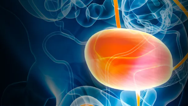 Bladder cancer image